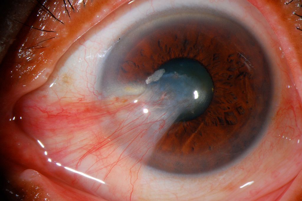 Los peligros del sol para los ojos y como elegir tus gafas de sol